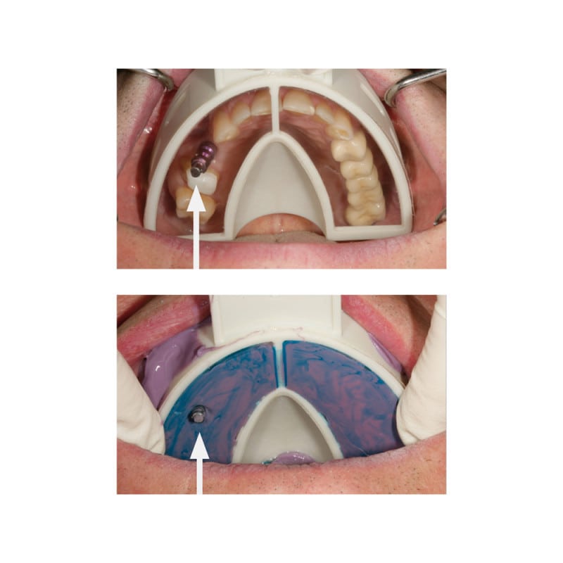 Miratray Implant Intro Kit